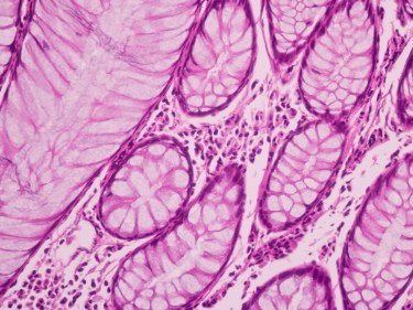 An image of purple cancer cells